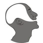 Dysarthria